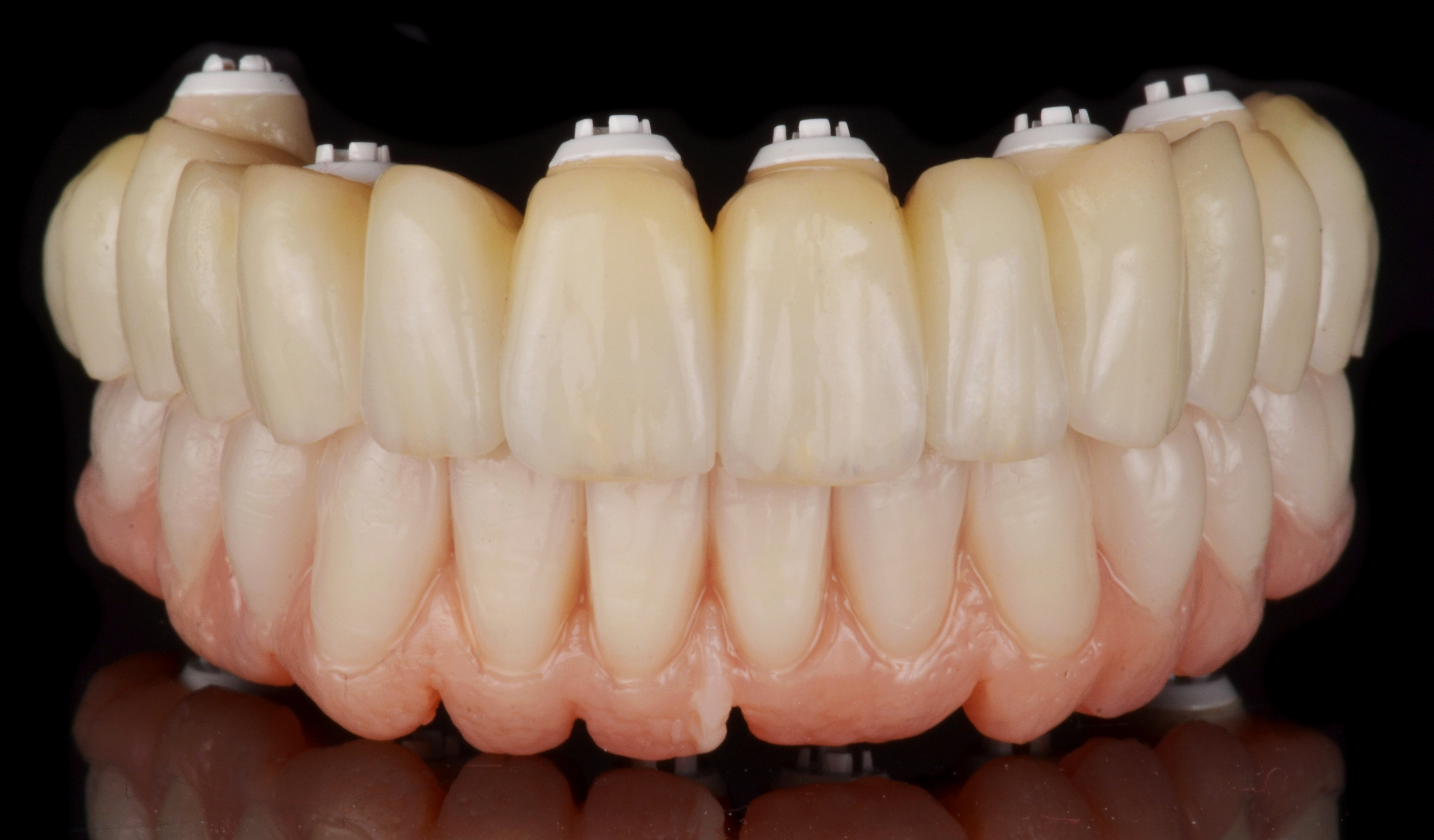 Réhabilitation BI-MAXILLAIRE IMPLANTS ZIRCONES (NOBEL PEARL) parution TD janvier 2024